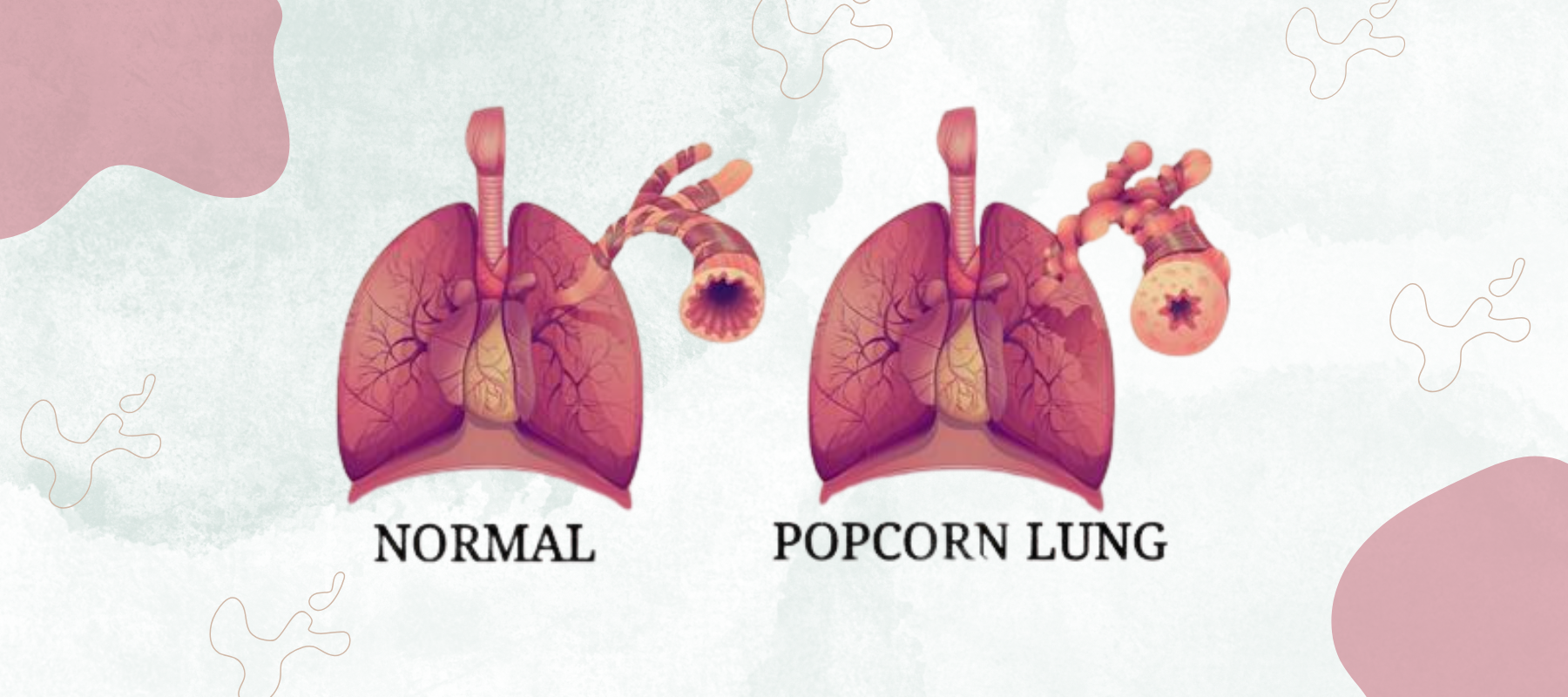 Popcorn Lungs